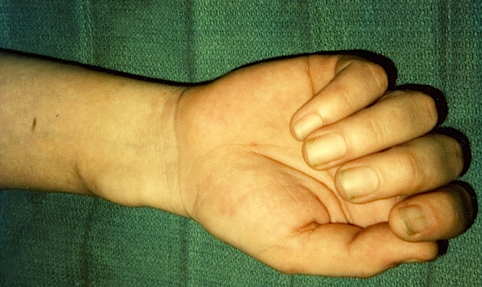 Volar Carpal Ganglion with palpable pulse