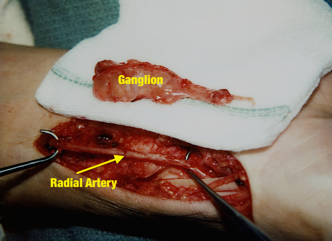 Excised Volar Ganglion with intact radial artery
