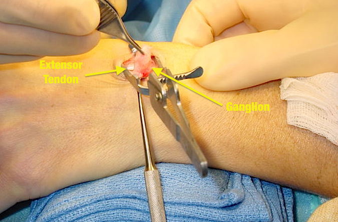 Excision of Dorsal Carpal Ganglion