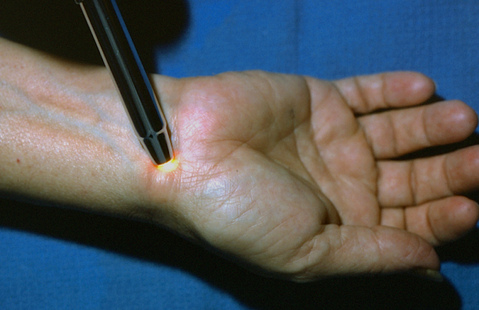 Ganglion does not transilluminate well if the skin thick and/or lesion does not protrude from skin plane.