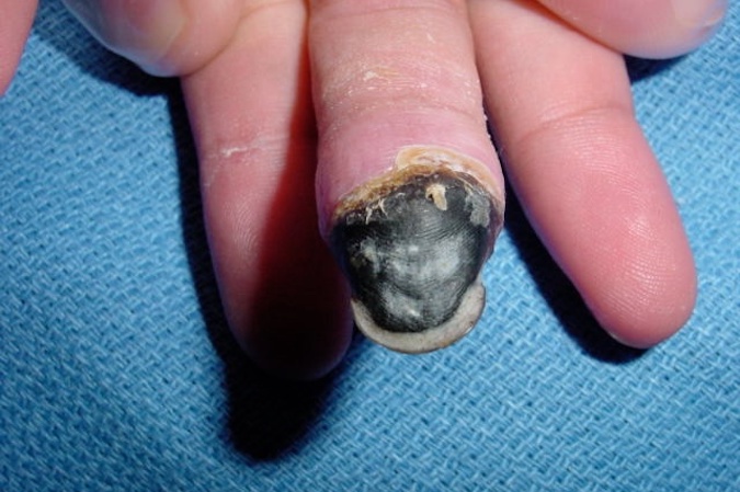 Dry gangrene associated with chronic diabetes and secondary peripheral vascular disease.