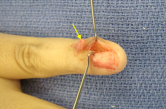 Left little finger glomus tumor excised (arrow).