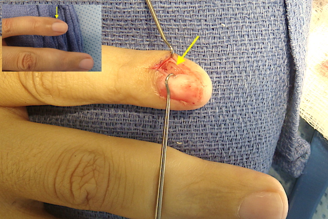 Left little finger glomus tumor after matrix incision with glomus (arrow) exposed.