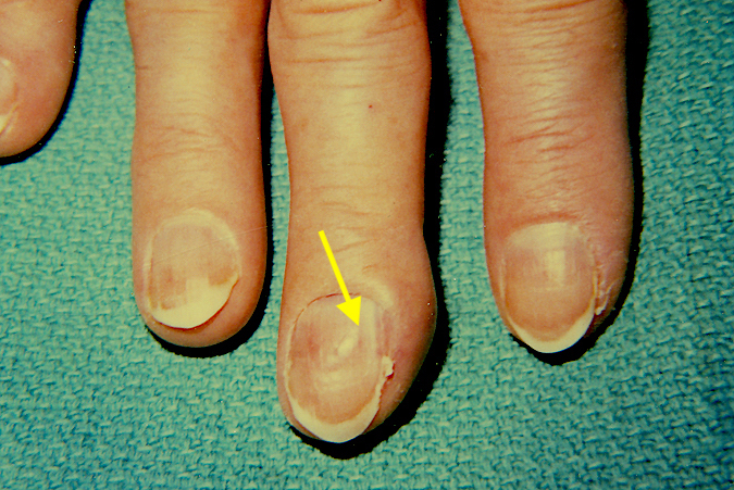 Glomus tumor just radial to midline of the nail . Note mild nail deformity at arrow.