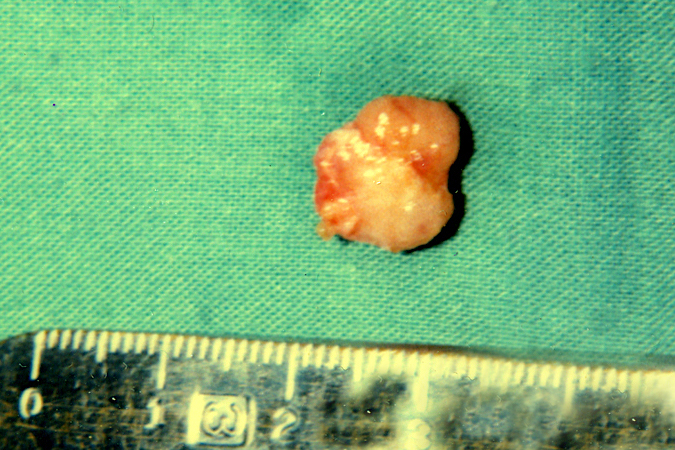 Right long finger glomus tumor about 1cm in diameter after excision.