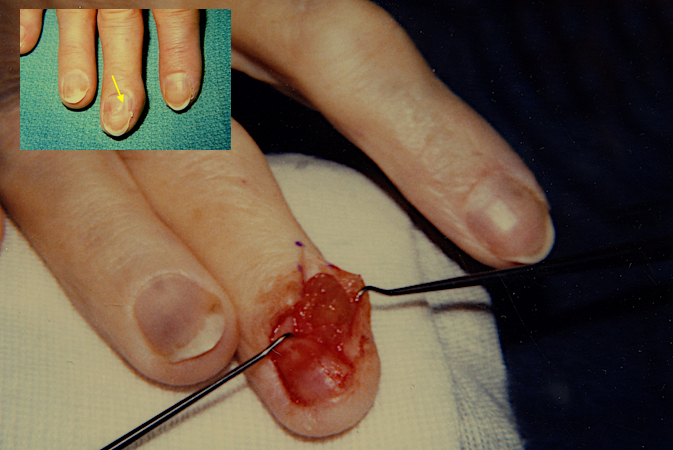 Right long finger glomus tumor excision.