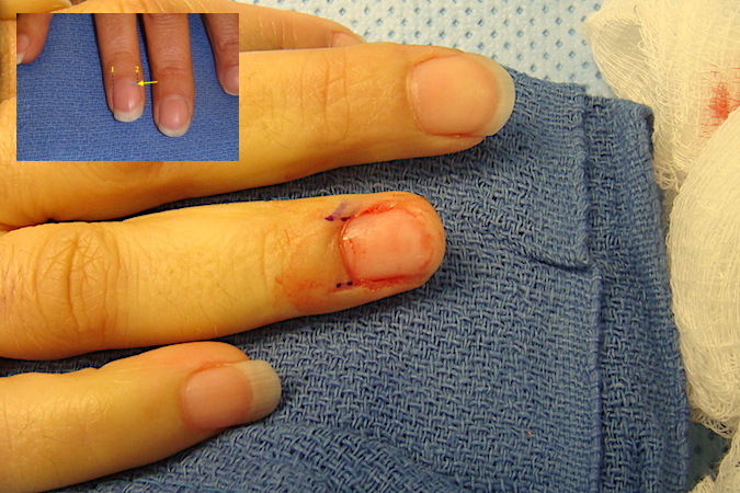 Right ring finger glomus tumor with nail off before matrix incision.