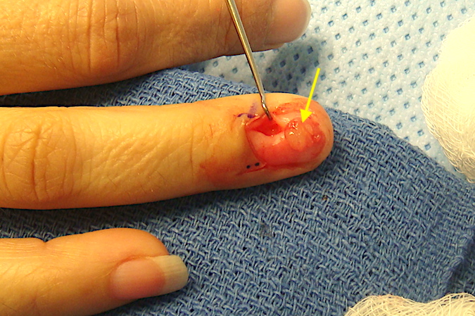 Right ring finger glomus tumor with glomus (arrow) excised.
