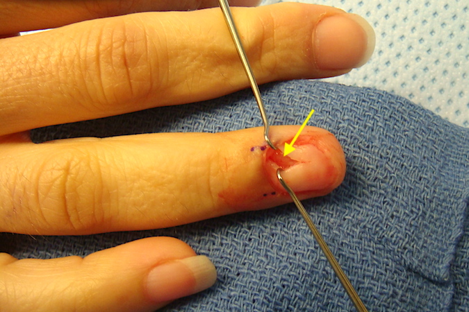 Right ring finger glomus tumor after matrix incision with glomus (arrow) exposed.