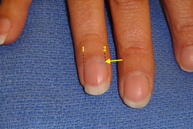 Glomus tumor radial corner of ring fingernail . Note blue/purplish discoloration at arrow and the planned incisions (1&2).