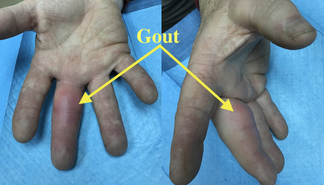 Acute Gout Long Finger causing pain and decreased range of motion