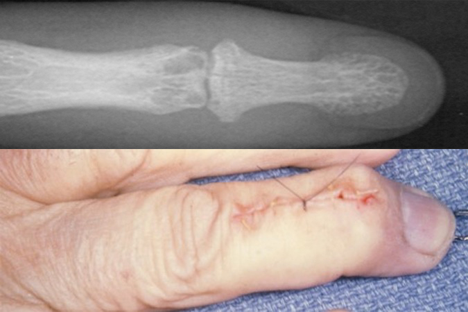 Gouty painful DIP treat with arthrodesis