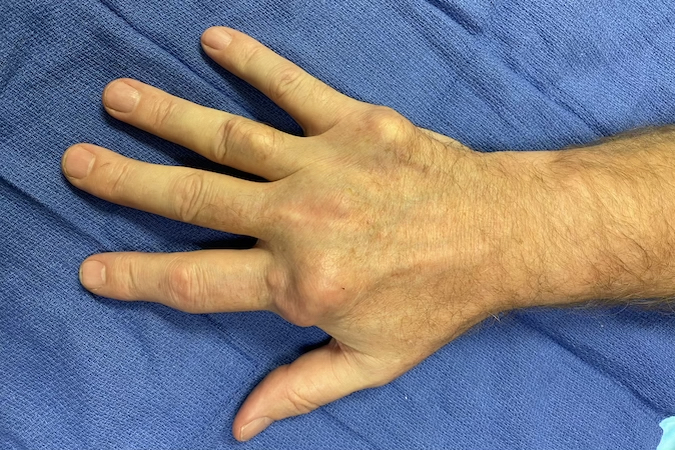 Tophaceous gout in right hand of a 57 year old male beer drinker.