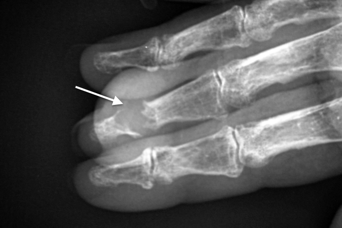 Severe tophaceous gout with DIP joint destruction and bone loss (arrow)