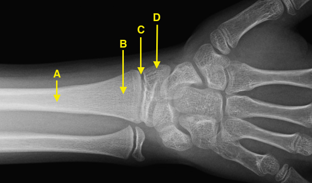 Normal Growth Plate  A = diaphysis; B = metaphysis; C = growth plate (epiphyseal plate); D = epiphysis