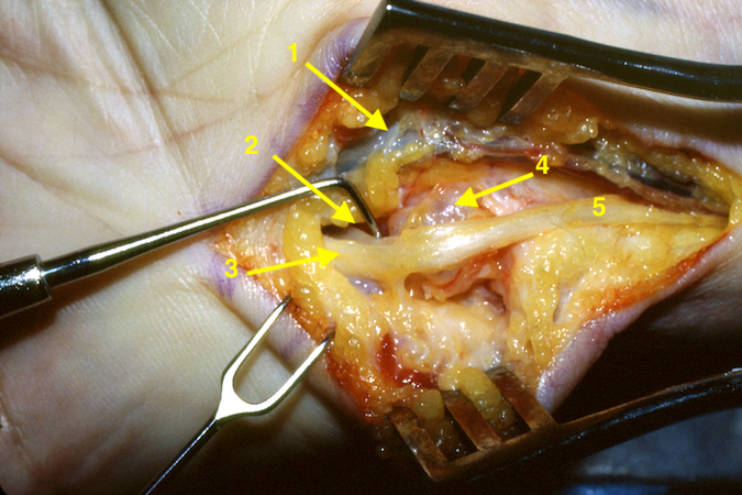 Guyon's canal dissected further with ulnar artery and vena comitans (1); motor branch of the ulnar nerve (2); sensory branch of the ulnar nerve (3); ganglion (4); and main ulnar nerve (5).