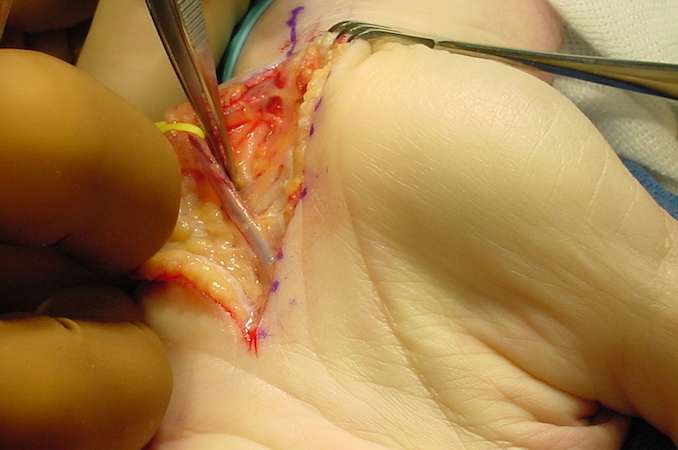 Ulnar artery retracted ulnarly (yellow vessel loop) and ulnar nerve at tip of the forceps.