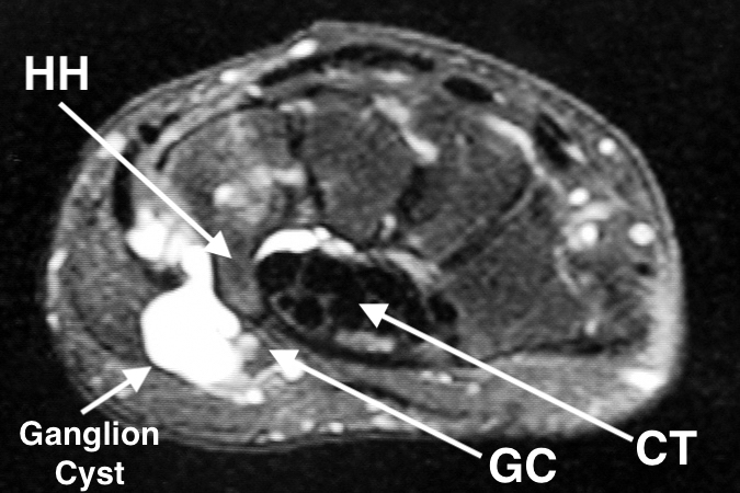 MRI showing hook of the hamate (HH) and a ganglion cyst  compressing the ulnar nerve in Guyon's canal (GC). Carpal tunnel (CT) also visible.