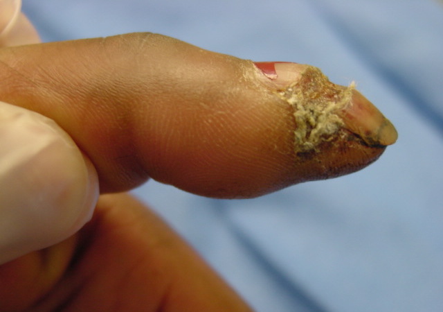 Neglected human bite of index nail and distal phalanx