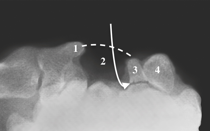 Hook of Hamate Fracture (curved arrow) nondisplaced; 1-Trapezial ridge, 2-carpal tunnel, 3-Hook of Hamate, 4-Pisiform; Dotted line = transverse carpal ligament