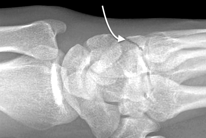 Hamate Dorsal Lip Fracture (curved arrow) nondisplaced
