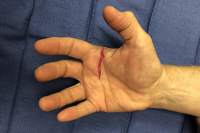 Palmar laceration the MP joints of the index & long. Structures at Risk: 1. Skin; 2.Tendons - FDP II&III and FDS II & III; 3. Digital Nerve Radial Index and Common Digital Nerves II-III web & III-IV; 4. Digital and Common Digital Arteries; 5. Bone - Metacarpal II & III; 6. Possibly MP Joints.   Note green stars at dorsal end of flexion creases.  The neurovascular bundle is immediately volar to these stars. (Click on structure to see exam)