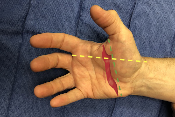 Palmar laceration through Guyon's Canal, distal Carpal Tunnel & base of Thenar Muscles. Structures at Risk: 1. Skin; 2.Tendons - all FDP and all FDS; 3. Nerves - Ulnar, Median or its branches; 4. Ulnar Artery, Superficial Arch & Deep Arch; 5. Bone - Metacarpal Bases or Carpal Bones.; 6. Possibly CMC Joints.   Green Kaplan's line cross yellow at median motor branch.  (Click on structure to see exam)