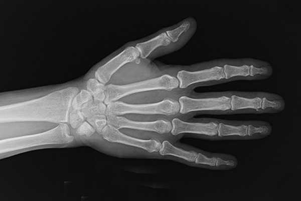 Right Hand AP view - phalanges and metacarpals.  Carpal bones, radius and ulna also visible .