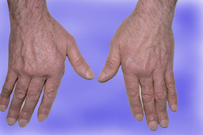Bilateral SLE hand deformities. Note the ulnar deviation of the fingers and the MP joint swelling and deformity especially on the right.