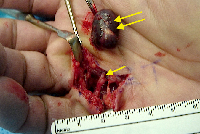 Excised hemangioma (double arrows) and exposed neurovascular bundle (single arrow).