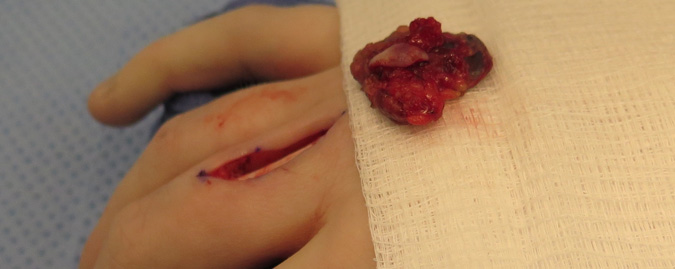 Hemangioma post excision - Extensor tendon visble in incision