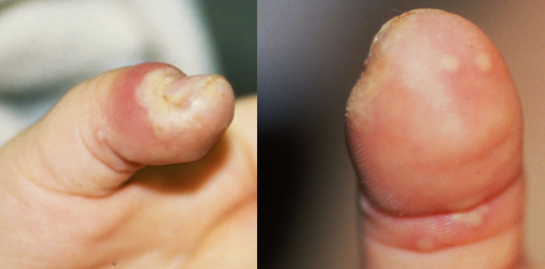 Herpetic Whitlow Left Thumb. Note classic vesicles (arrows)