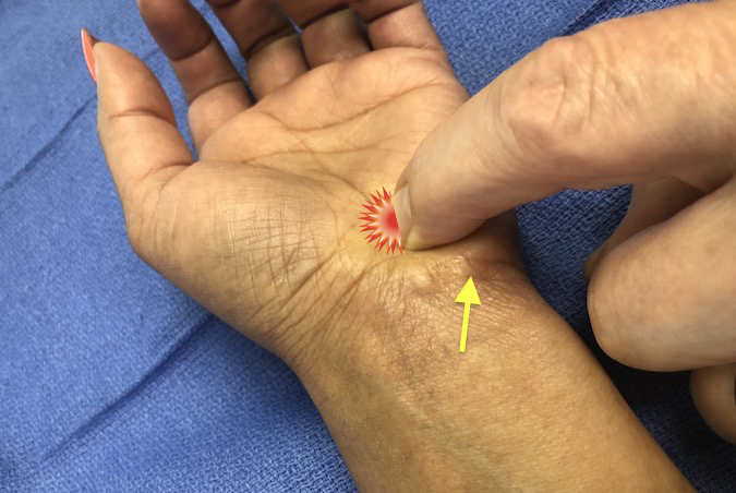 Palpation for tenderness at the hook of the hamate (arrow at pisiform)