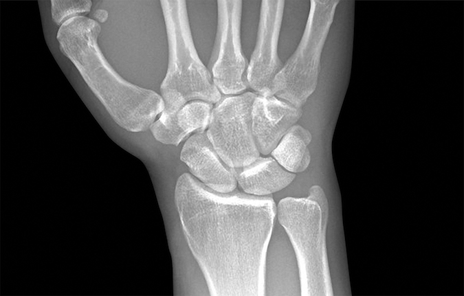 Routine AP Wrist X-ray does not demonstrate the hook of hamate fracture.