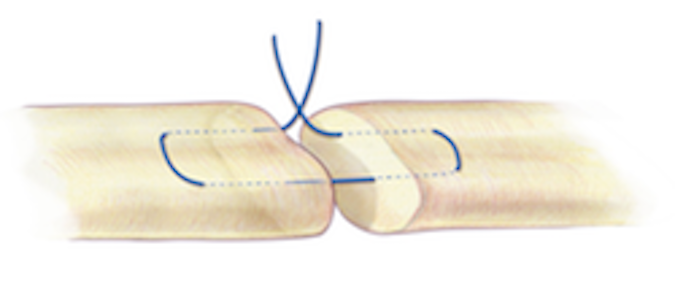 A horizontal mattress suture or one where the longitudinal part of the suture passes under instead of through the tendon can sometimes be helpful in finger extensor repairs.  A 3-O or 4-O  braided synthetic permanent suture is one acceptable suture  choice for the the core suture.