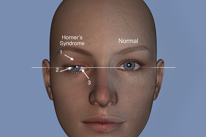 Horner’s sign is frequently associated with C8 and T1 root avulsions which also damage the sympathetic fibers to the face and may produce an ipsilateral Horner’s sign: 1) Ptosis (drooped eyelid); 2) meiosis (constricted pupil); 3) enophthalmos (sunken globe).  Horner’s sign is associated with anhydrous of the ipsilateral face and a poor prognosis when connected with a brachial plexus injury.7