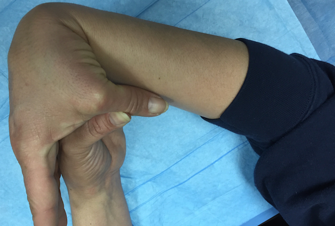 Hyperligamentous laxity of thumb - relatively uncommon but normal variant