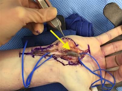 Hypothenar (Ulnar) Hammer Syndrome after surgical exposure of ulnar artery thrombosis (arrow).