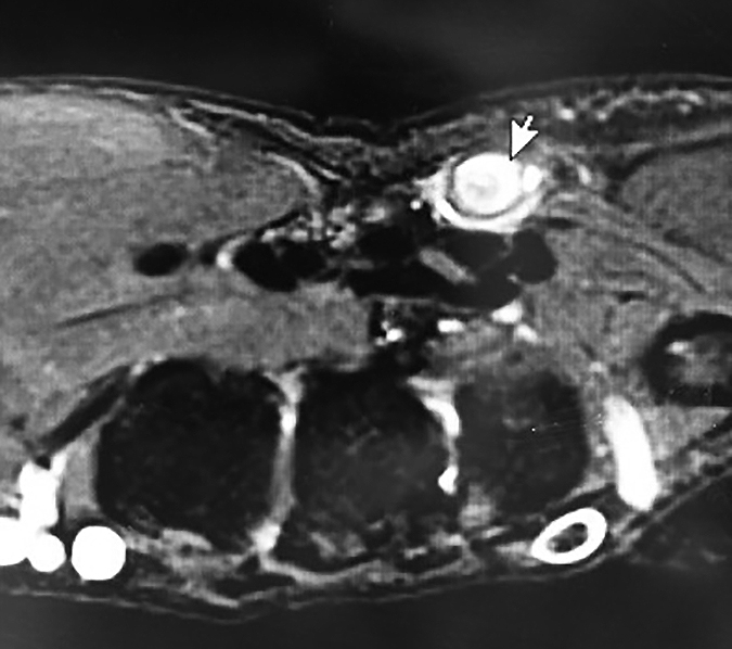 MRI cross-sectional image with thromboses ulnar artery( See arrow)
