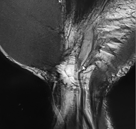 MRI AP image with thromboses ulnar artery (See arrow)