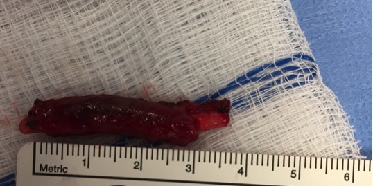 Excised ulnar artery thrombosis.