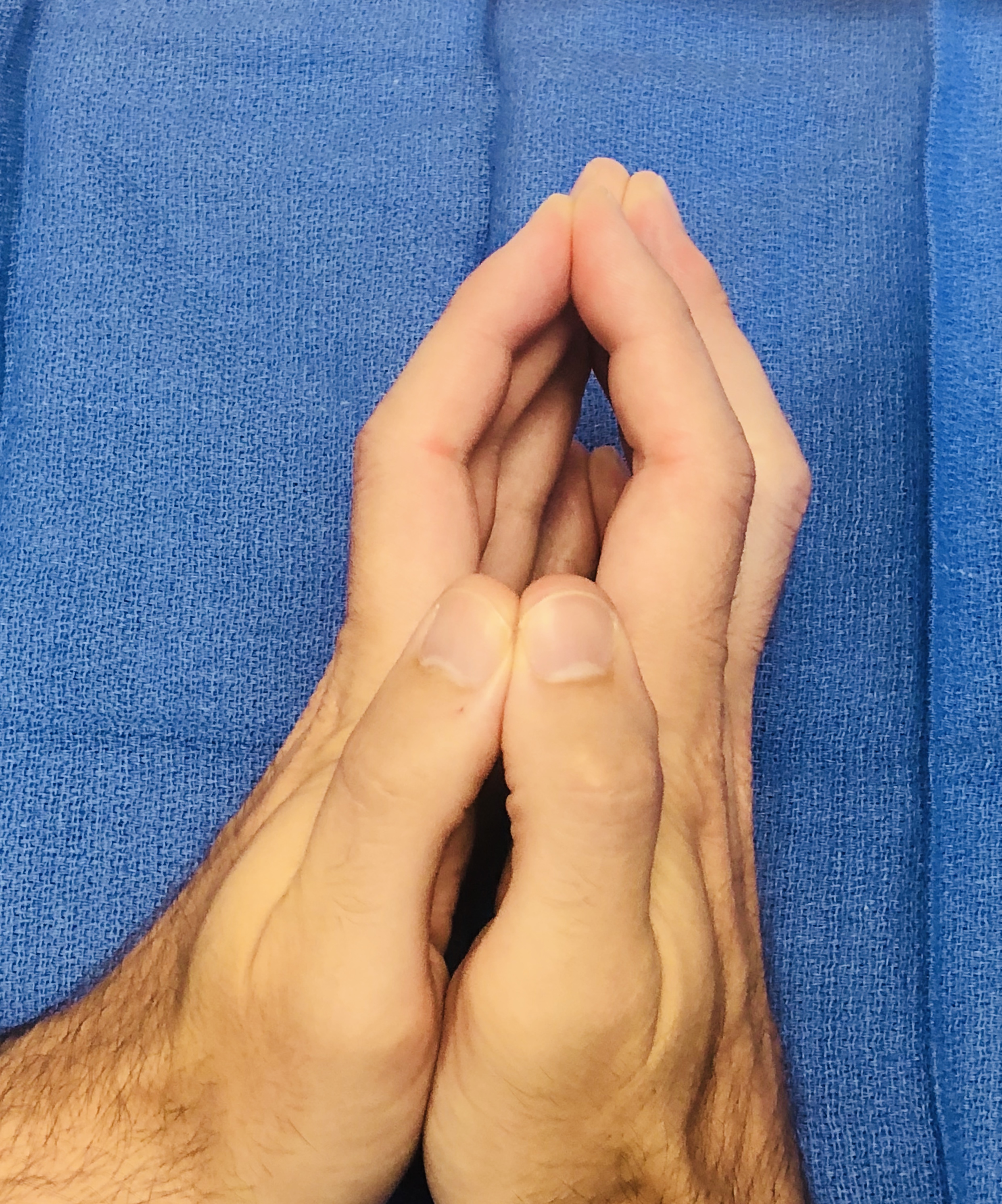 Limited joint mobility secondary to diabetes with positive Prayer sign.  Positive sign secondary to joint stiffness and contractures especially in the PIP joints.