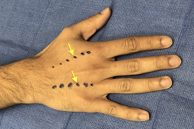 Incisions for dorsal hand compartment releases