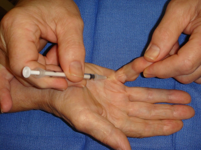Initial technique for needle insertion and collagenase injection