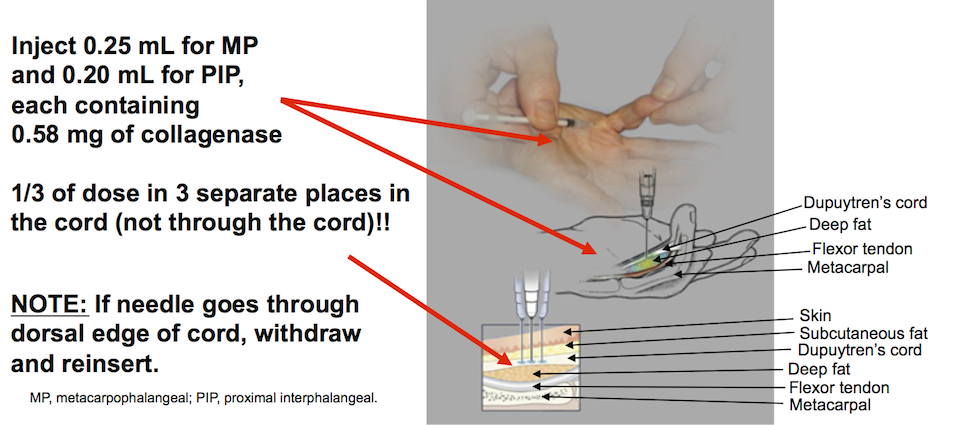 Current dose and needle positioning technique