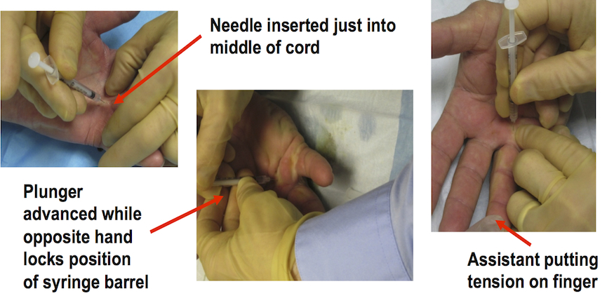 Latest injection technique to inject separate aliquots and keep them in the cord