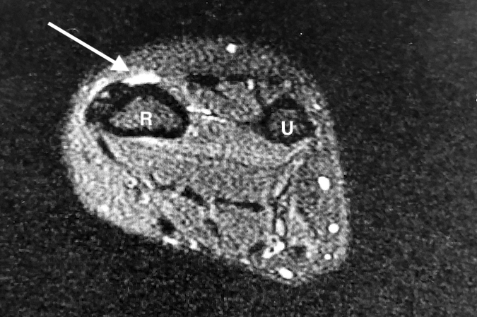MRI showing fluid (arrow) in intersection of AbPL and ECRL&B