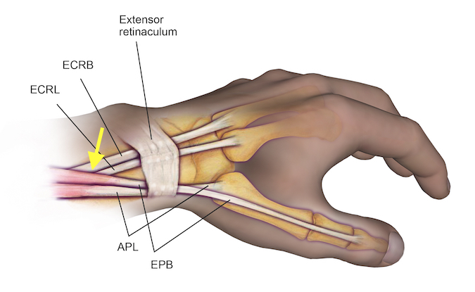 Intersection Syndrome is caused by inflammation in the area (arrow) between the radial wrist extensors (ECRB&ECRL) and the thumb abductor and extensor (APL & EPB)