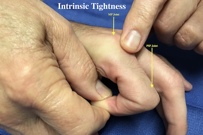 This patient has a intrinsic contracture. When the MP join is flexed the PIP joint can flexion normally.