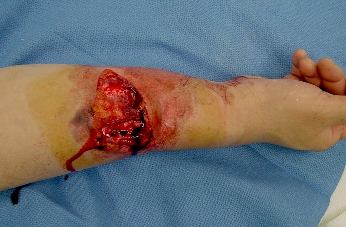 Right open distal -third transverse radius and ulna fractures with transverse wound over the radius.